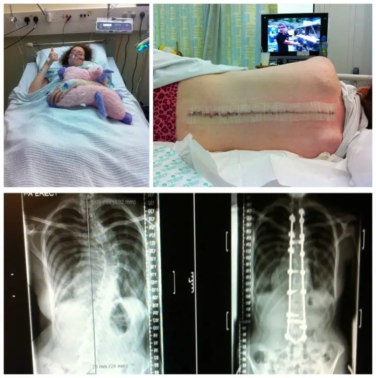 Shona after operation for scoliosis