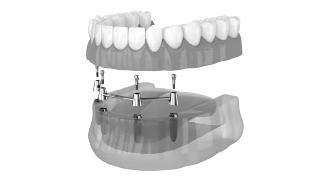 Diagram of an All-on-4 dental implant system, showing a full upper set of teeth supported by four implants anchored into the jawbone.