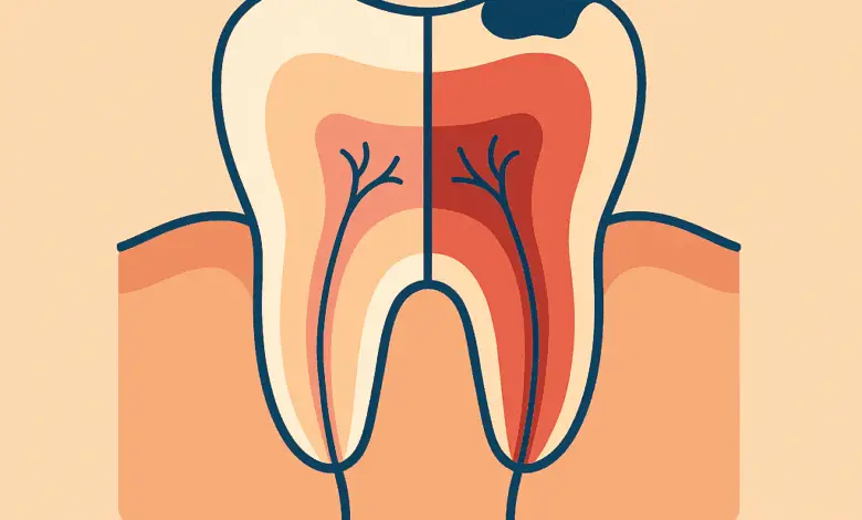 Flat cartoon-style cutaway of a tooth showing pulpitis: one half labeled “Reversible” (healthy pulp, light pink), the other “Irreversible” (inflamed red pulp). Simple diagram with minimal labels and clear shapes. Friendly rounded style, off-white and navy blue tones for contrast, Warm Beige background.